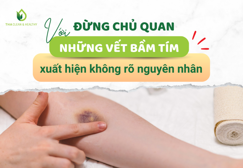 ĐỪNG CHỦ QUAN VỚI NHỮNG VẾT BẦM TÍM XUẤT HIỆN KHÔNG RÕ NGUYÊN NHÂN