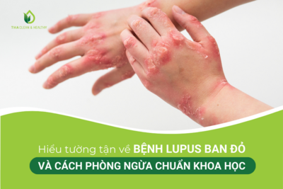 HIỂU TƯỜNG TẬN VỀ BỆNH LUPUS BAN ĐỎ VÀ CÁCH PHÒNG NGỪA CHUẨN KHOA HỌC