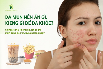 Da mụn nên ăn gì, kiêng gì để da khỏe?
